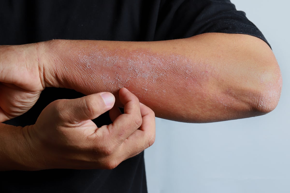 Can CBD Oil Cure Eczema?